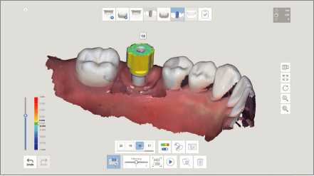 A.I. Abutment и A.I. Scan Body Matching в Medit i500